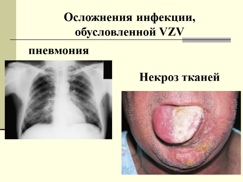 Осложнения инфекции, обусловленной VZV пневмония Некроз тканей